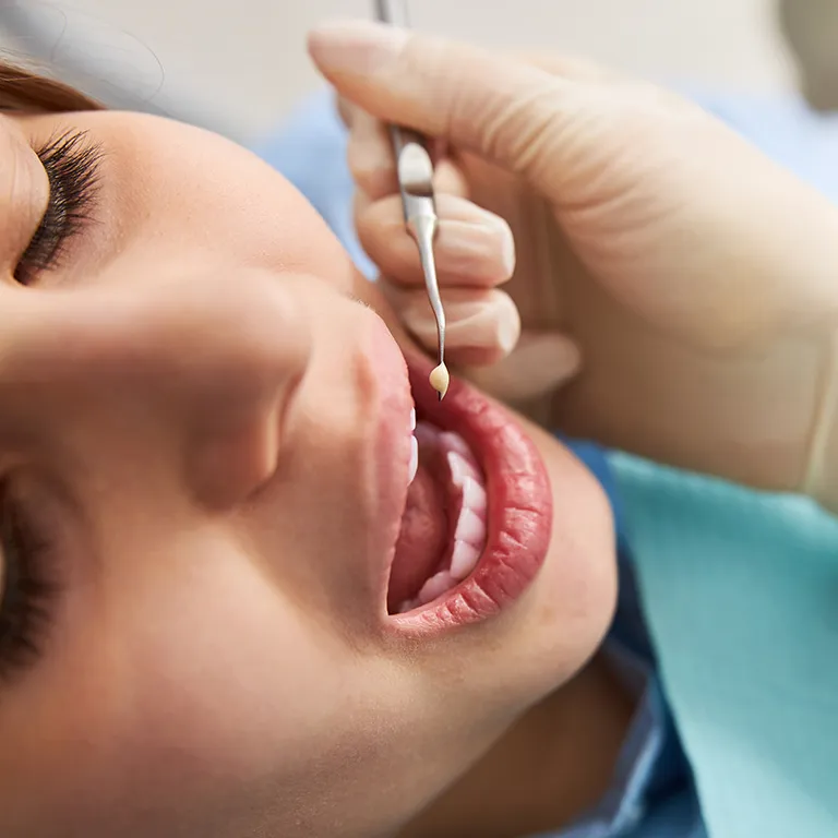 Image of a dentist putting filling into a mouth