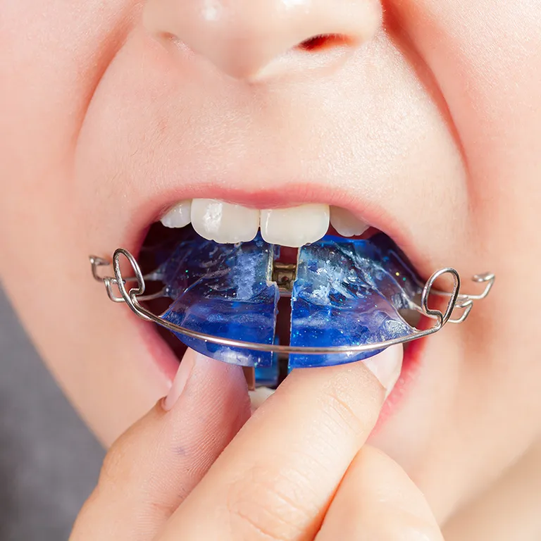 Image of a child pointing to a blue mouth guard