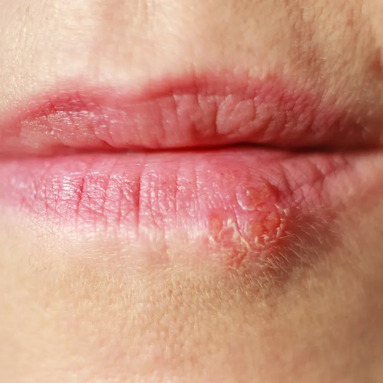 Image of a womans lip with a cold sore