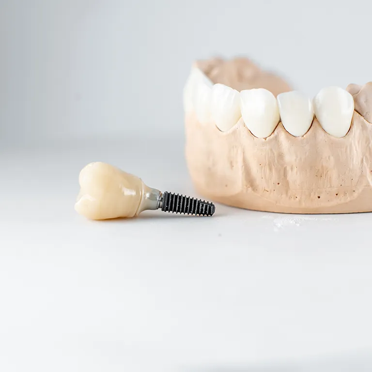 Image of a tooth implant next to a model of teeth