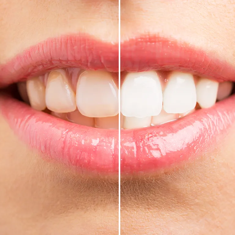 Before and after image of whiter teeth